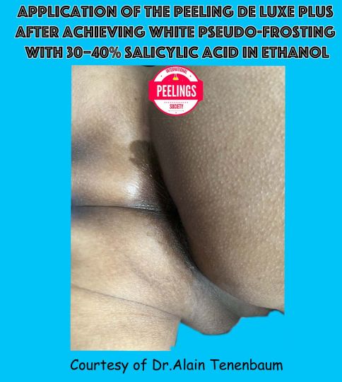 peeling de luxe after white pseudo frosting with salicylic acid in ethanol