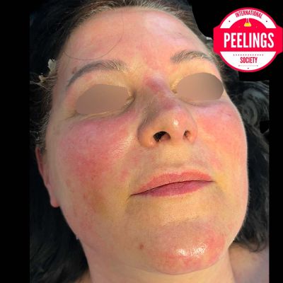 skin aspect at the end of application of 30 min peel off before removal