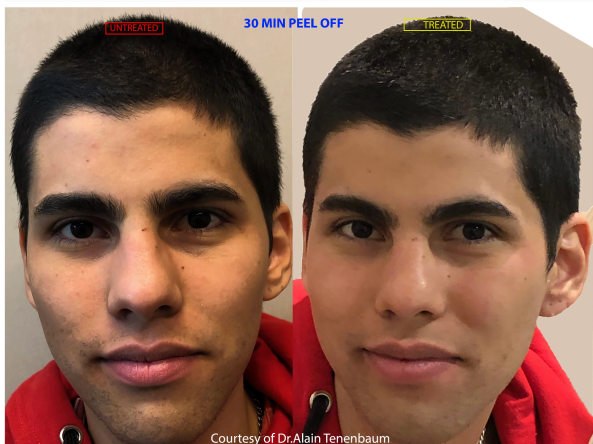 treatment of comedones