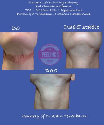 neck-hyperchromy-stability