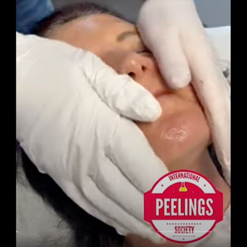 massage the face with peeling de luxe plus 