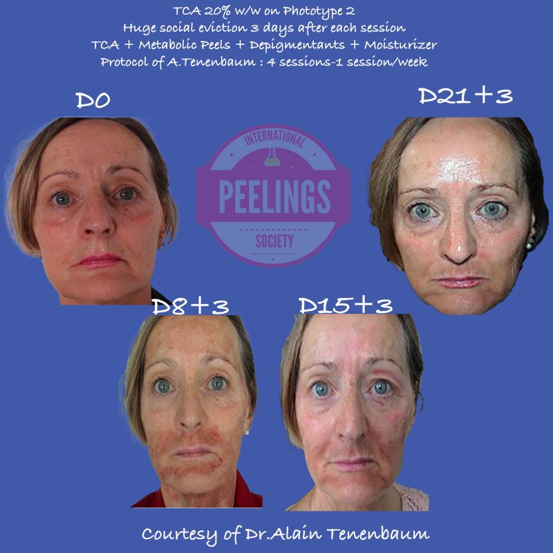 social eviction 3 days after each session of TCA>20% w/w