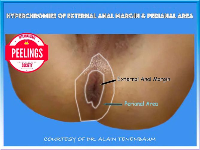 hyperchromies of external anal margin and perianal area