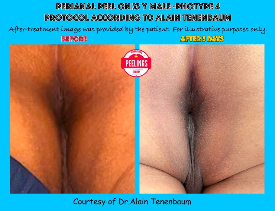 1st results metabolic peel on perianal area on D0 -D3