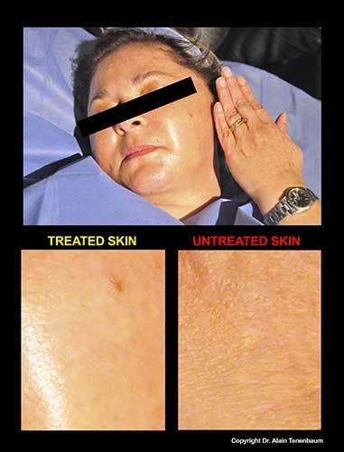 results/peeling-de-luxe3.