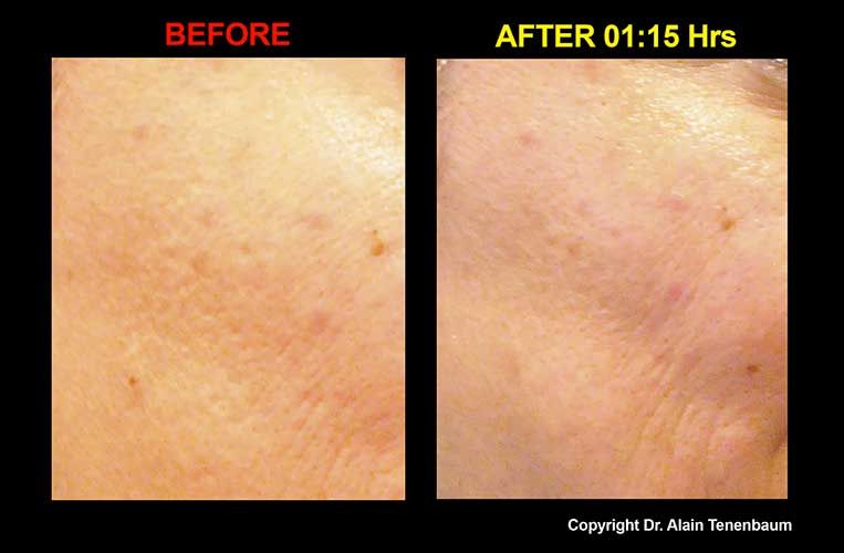 results/peeling-de-luxe5.