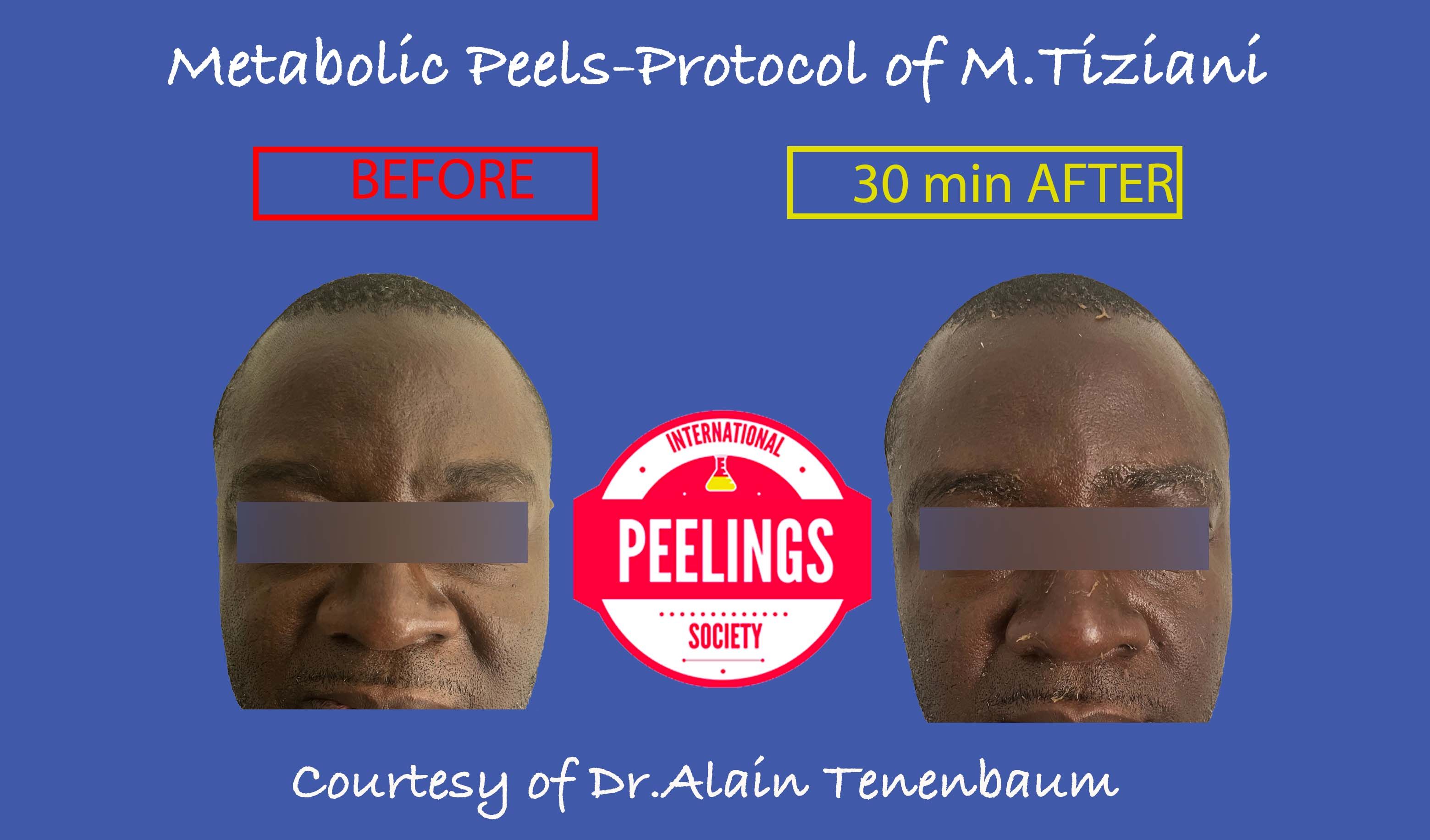 metabolic peel on black skin