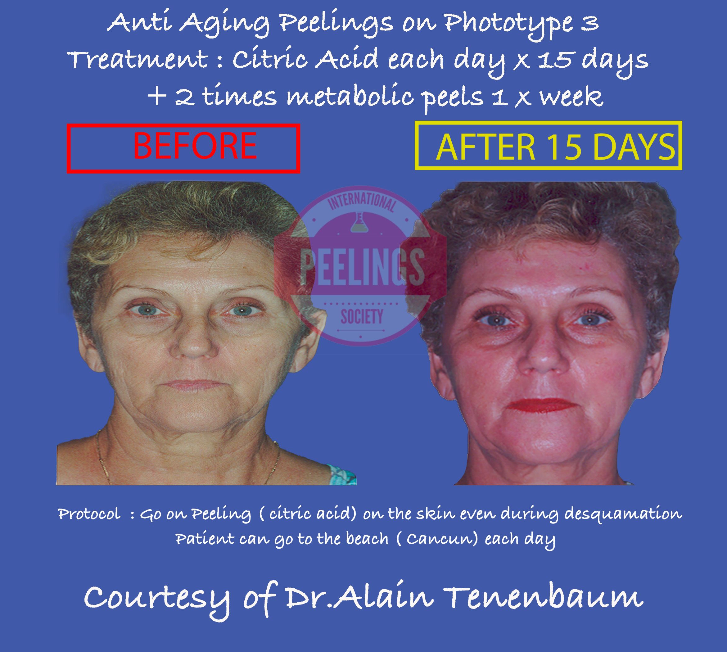 mexican-female-antiaging-peel