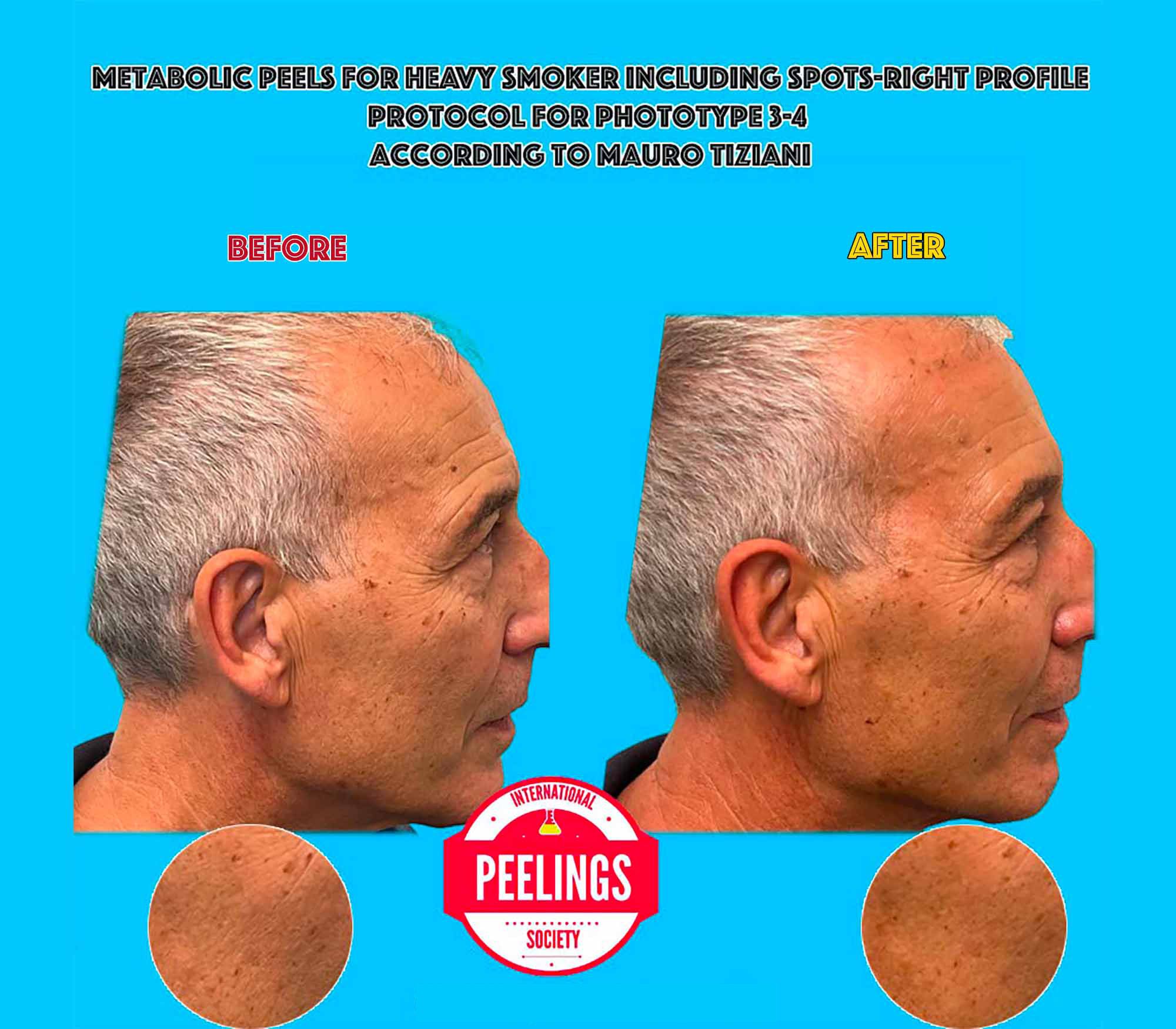 smokers skin metabolic peels side pic