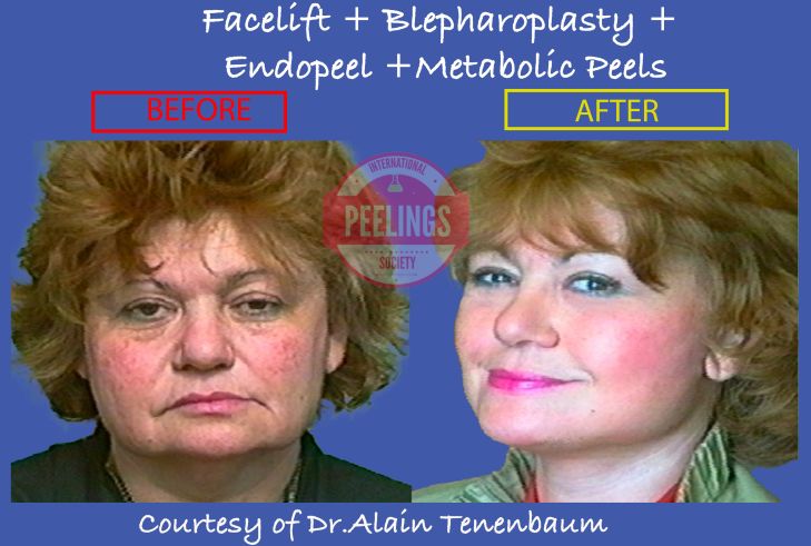 facelift-blefaro-endopeel-metabolic-peels