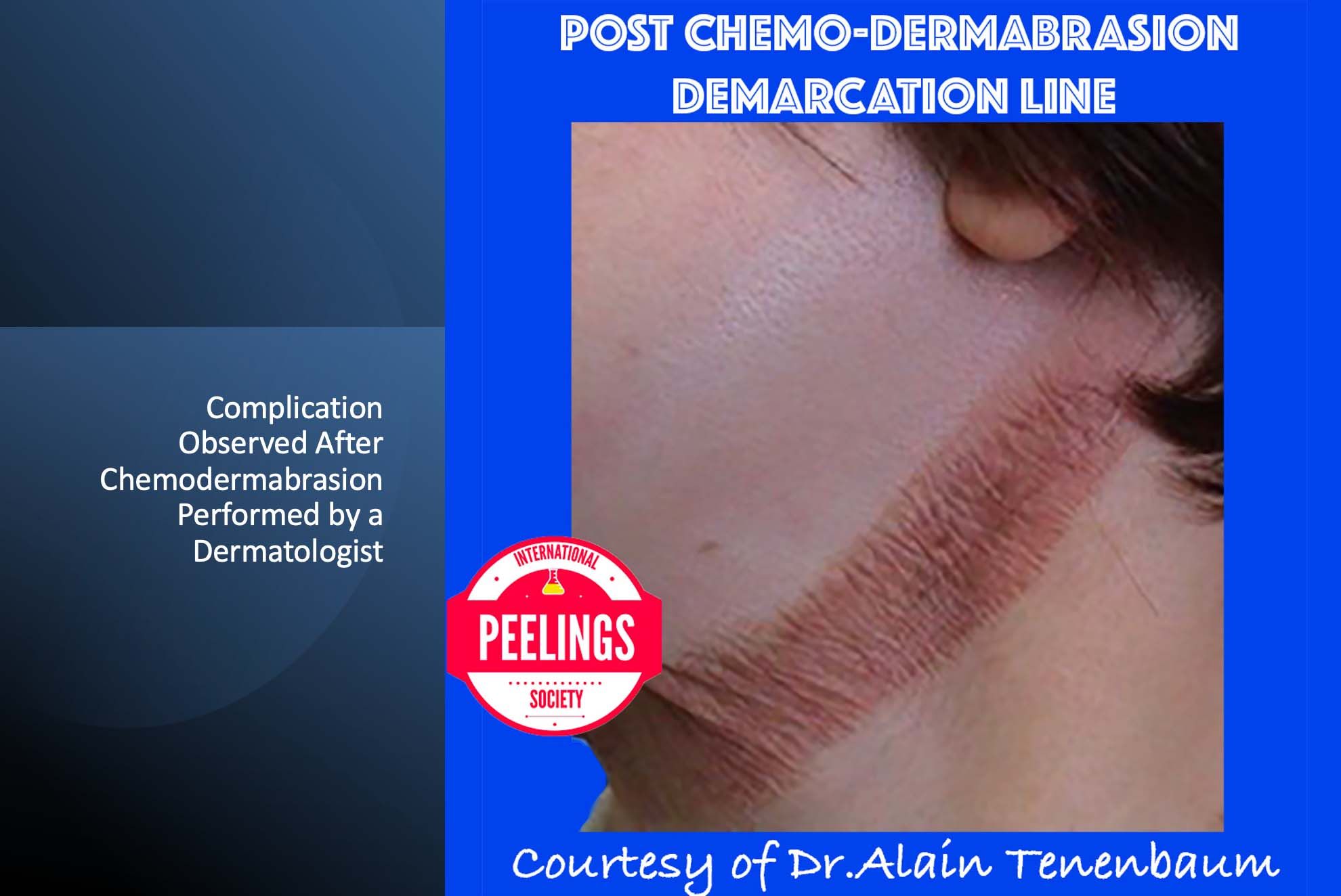 Post Chemodermabrasion Demarcation Line