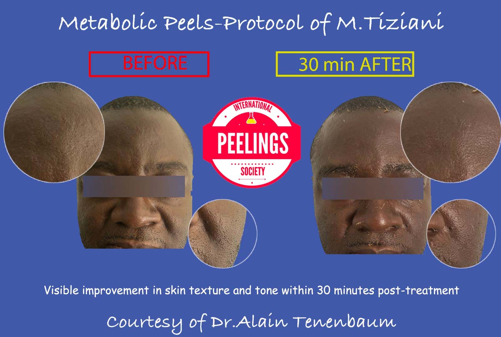 zoom-metabolicpeel-blackskin