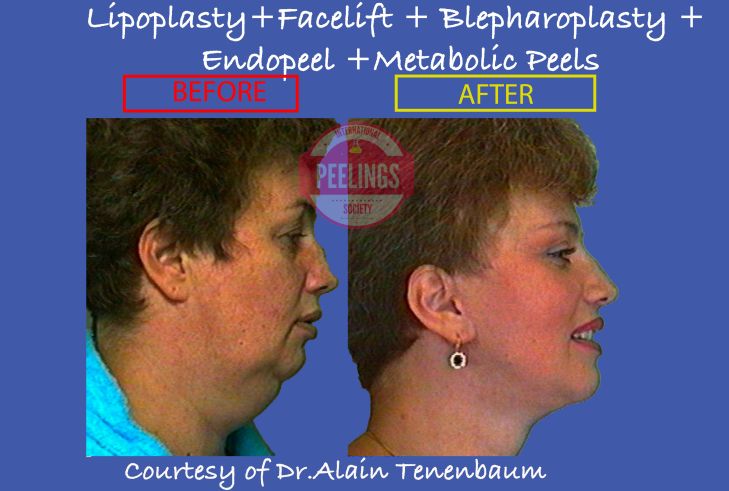 profile-view-surgery-endopeel-metabolic-peels